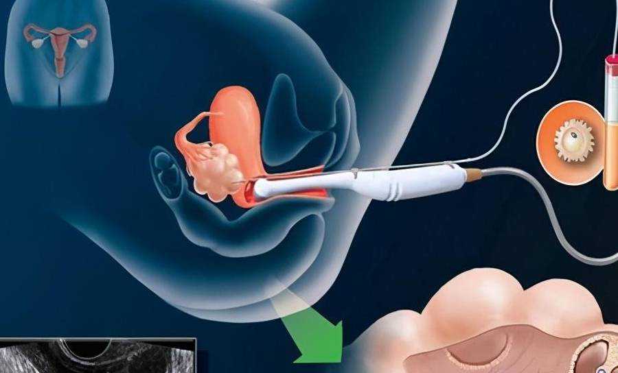 重庆试管婴儿流程详解：精子库助孕与代生服务指南